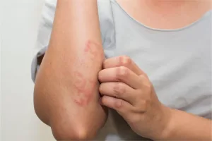 Eczema and Your Diet